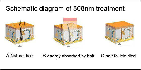 गर्म 808nm डायोड लेजर बालों को हटाने के अल्मा सद्भाव